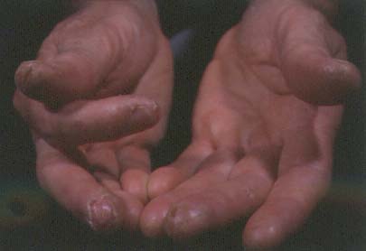 [Bild, Sjukdomssymptom]